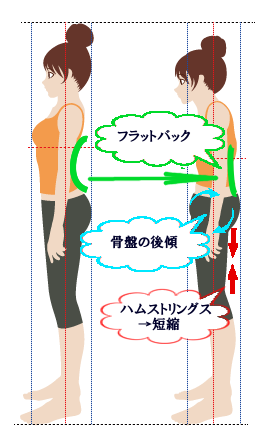 ハムストリングス両側短縮による姿勢変化のイラスト