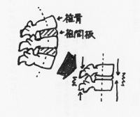 腰椎がフラットになることで腰椎椎間板が薄くなっているイメージのイラスト