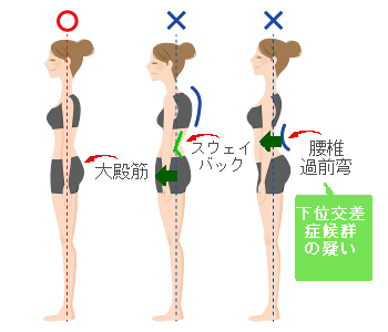 スウェイバックや腰椎過前弯を示したイラスト図