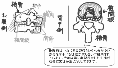 背骨の分節と椎間板の変性をイメージしたイラスト